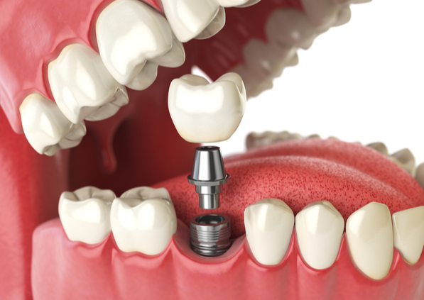 IMPLANTS-Right-side
