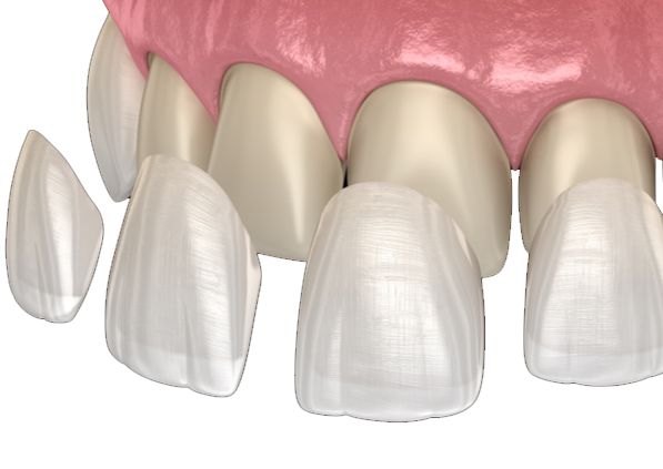 VENEERS-Right-side