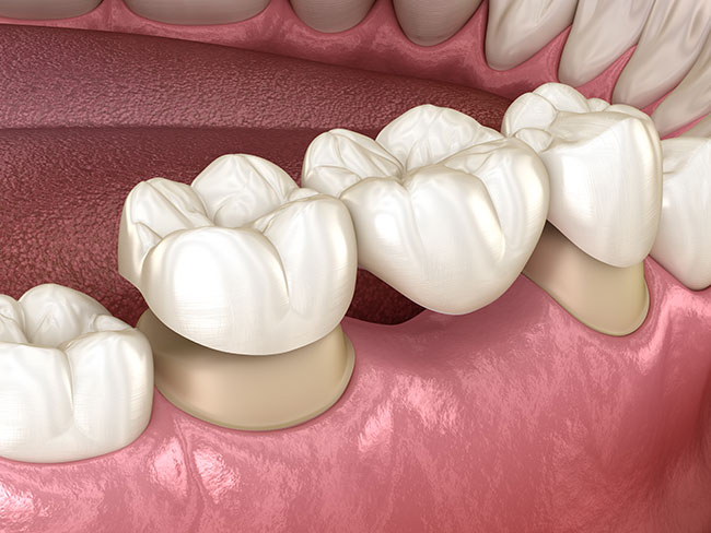 dental bridge