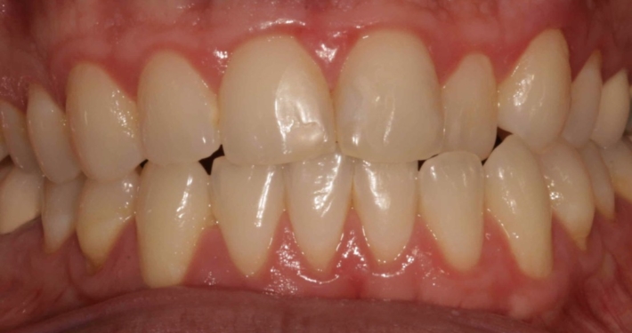 Invisalign1