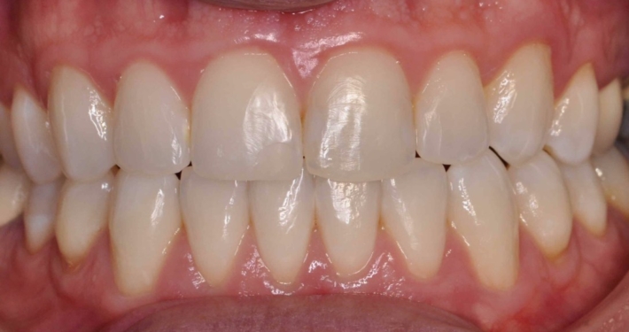 Invisalign2