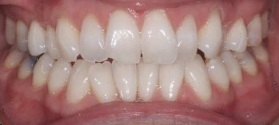 IMG_9987 Pre Invisalign/Whitening/Bonding (by Dr Mat Lowis)